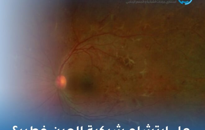 هل ارتشاح شبكية العين خطير