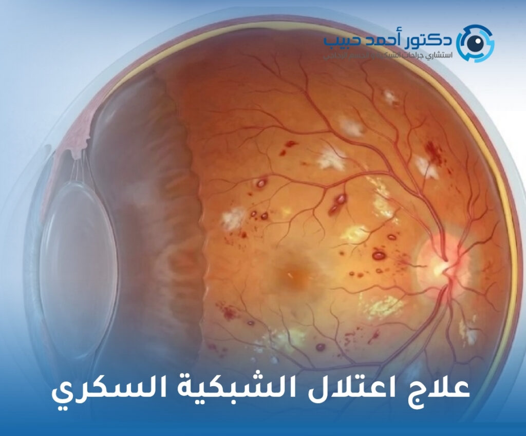 علاج اعتلال الشبكية السكري