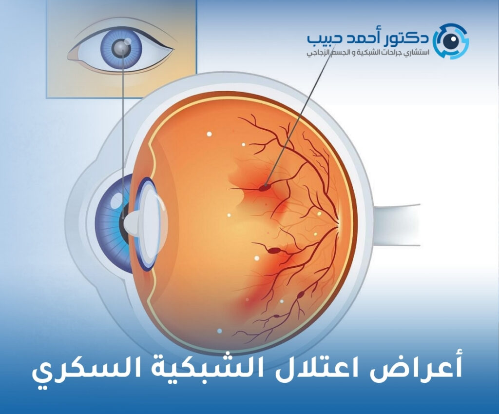 أعراض اعتلال الشبكية السكري