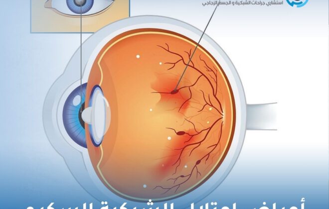 أعراض اعتلال الشبكية السكري