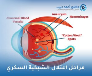 مراحل اعتلال الشبكية السكري
