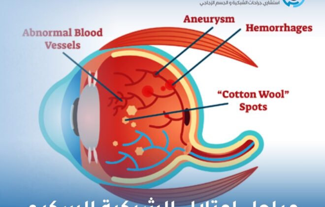 مراحل اعتلال الشبكية السكري