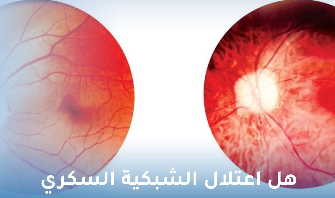 هل اعتلال الشبكية السكري يسبب العمى