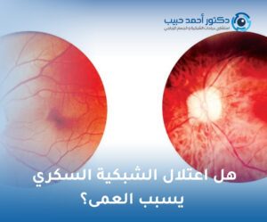 هل اعتلال الشبكية السكري يسبب العمى