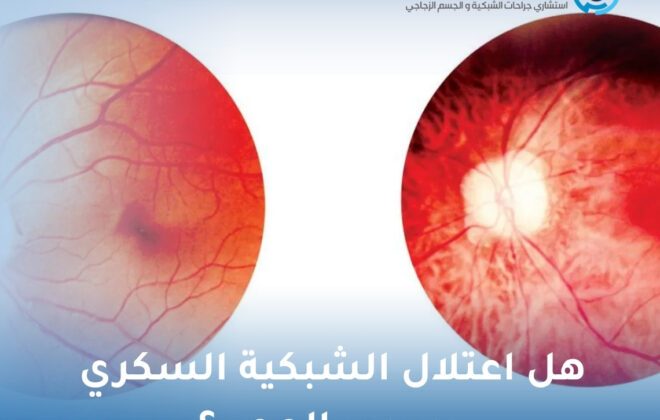 هل اعتلال الشبكية السكري يسبب العمى