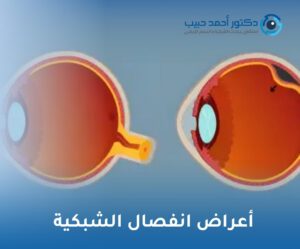 أعراض انفصال الشبكية