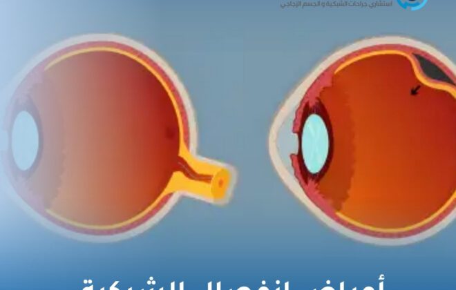 أعراض انفصال الشبكية