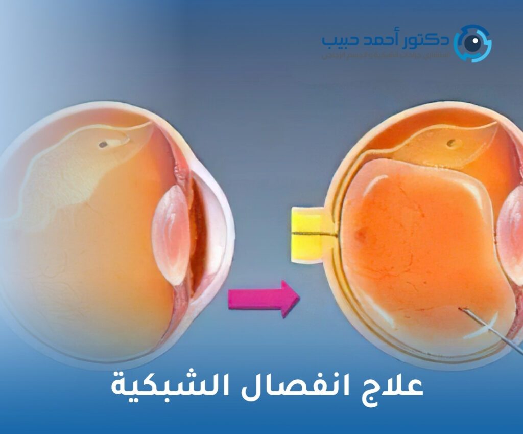 علاج انفصال الشبكية