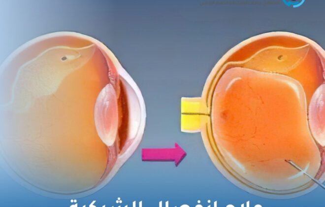 علاج انفصال الشبكية