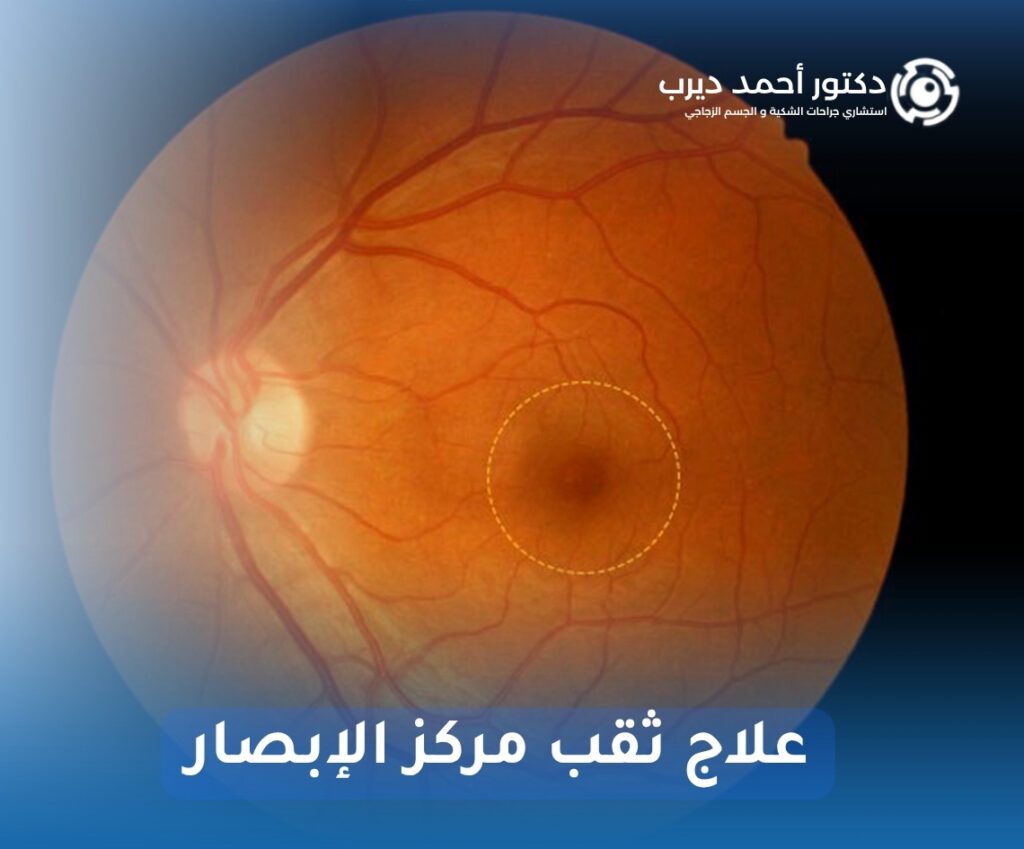 علاج ثقب مركز الإبصار
