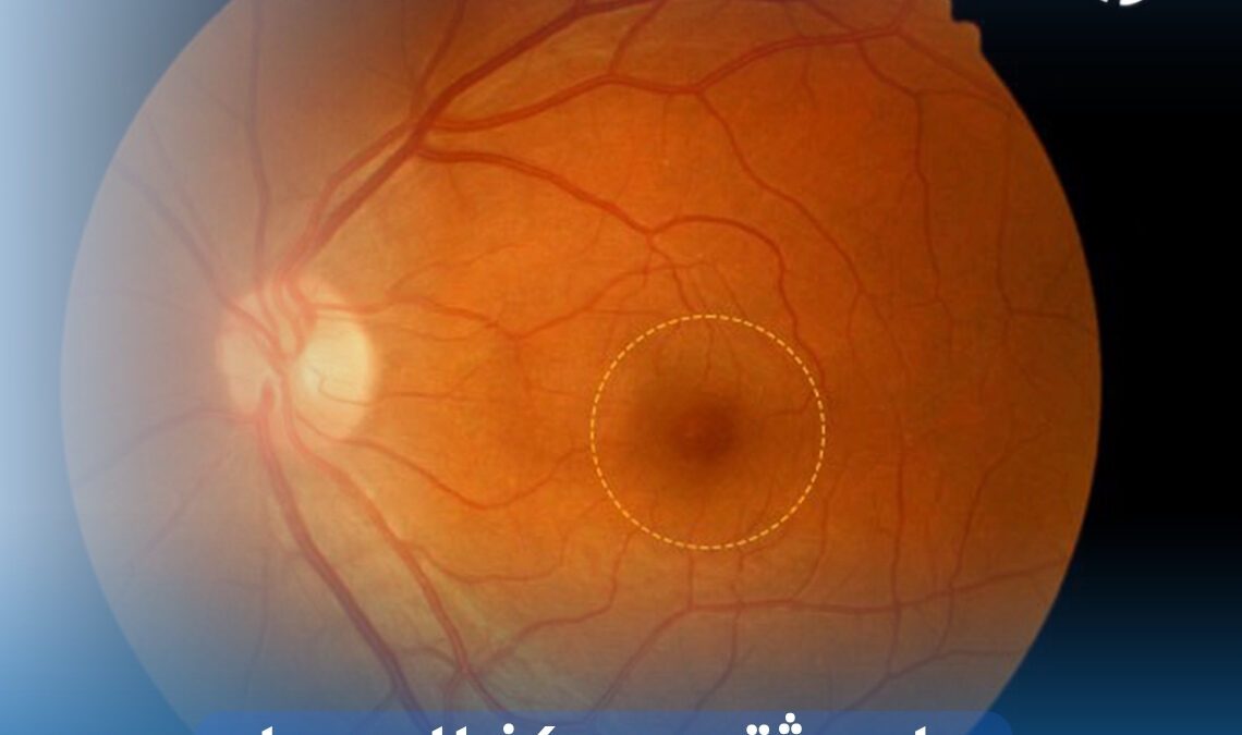 علاج ثقب مركز الإبصار