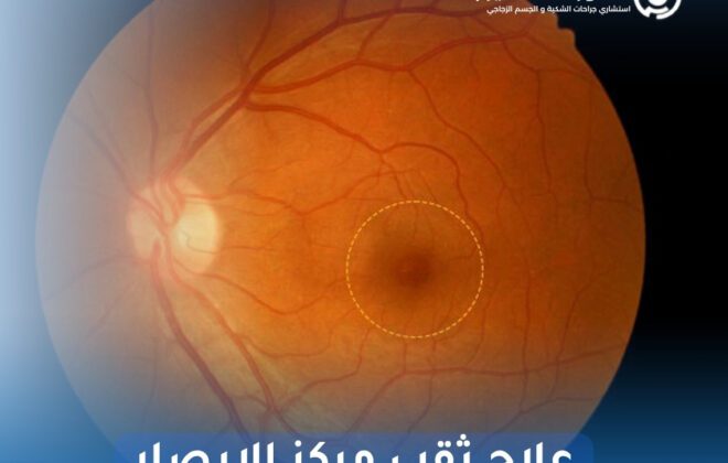 علاج ثقب مركز الإبصار