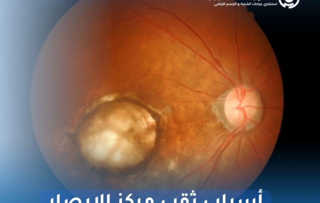 أسباب ثقب مركز الإبصار
