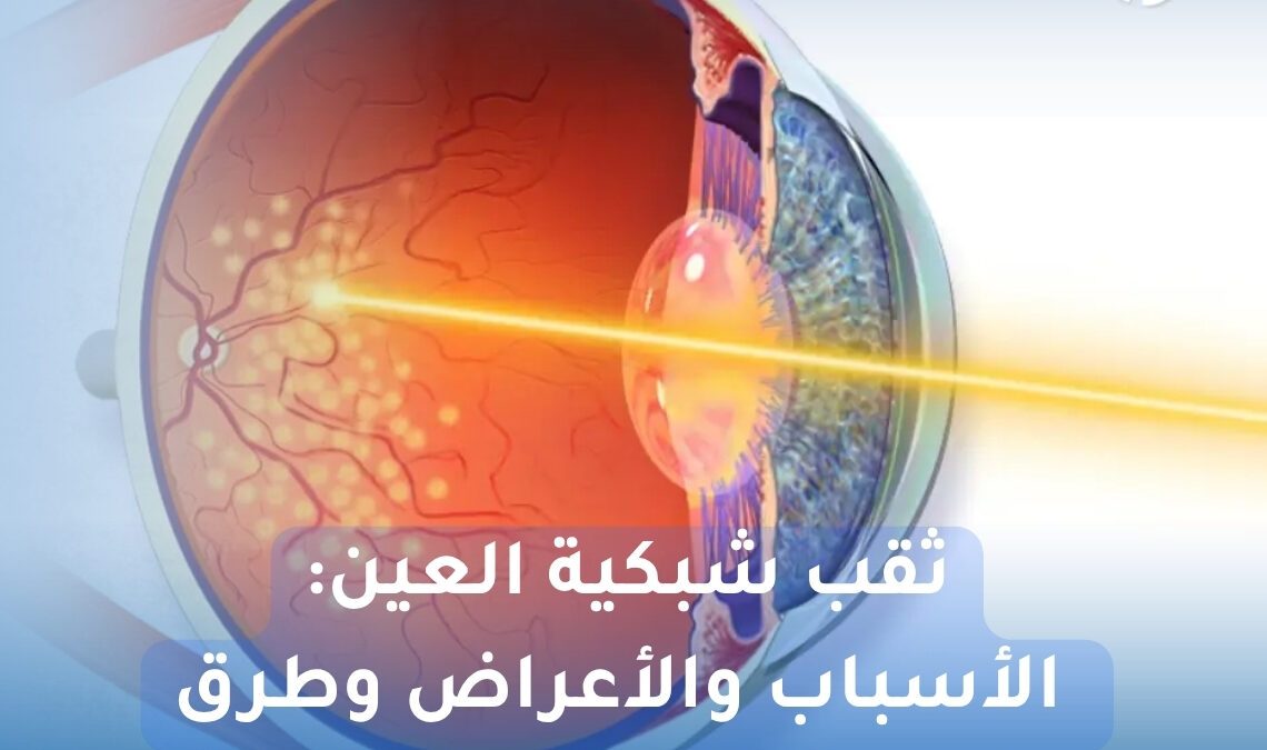 ثقب شبكية العين
