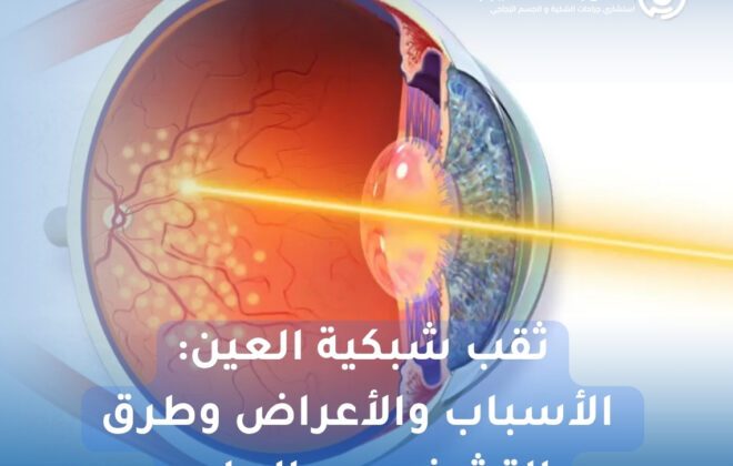 ثقب شبكية العين