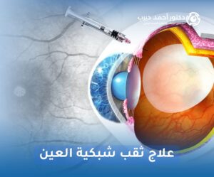 علاج ثقب شبكية العين