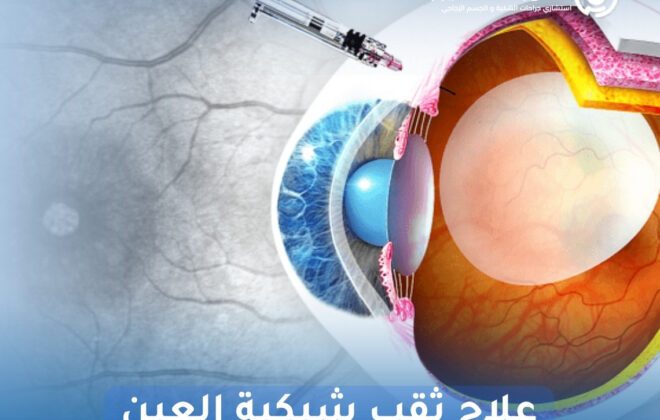 علاج ثقب شبكية العين