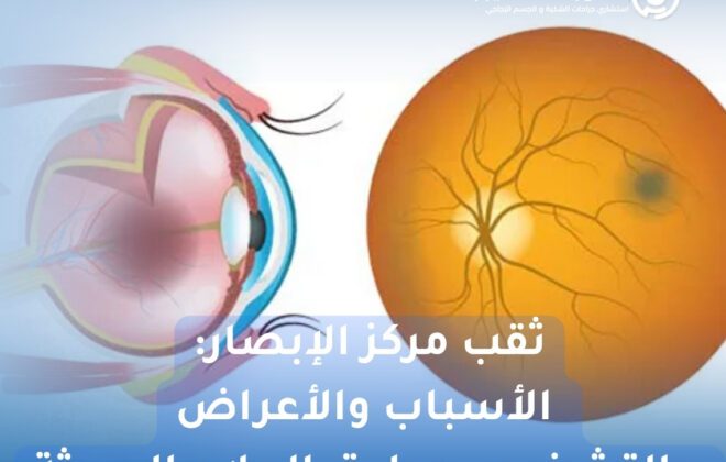 ثقب مركز الإبصار