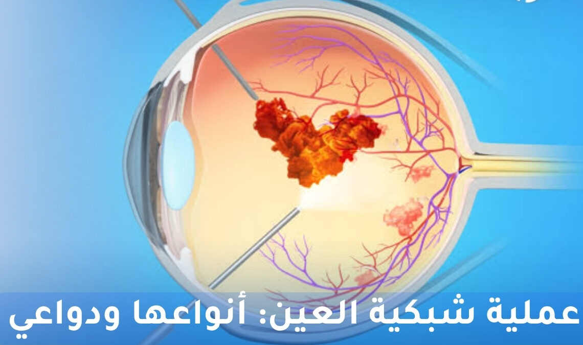 عملية شبكية العين