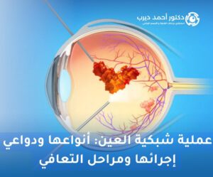 عملية شبكية العين