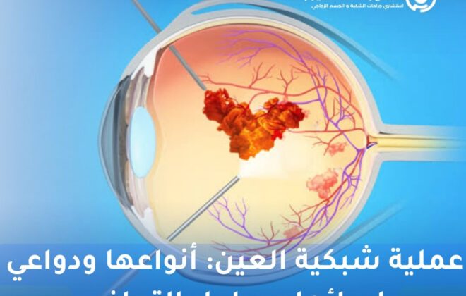 عملية شبكية العين