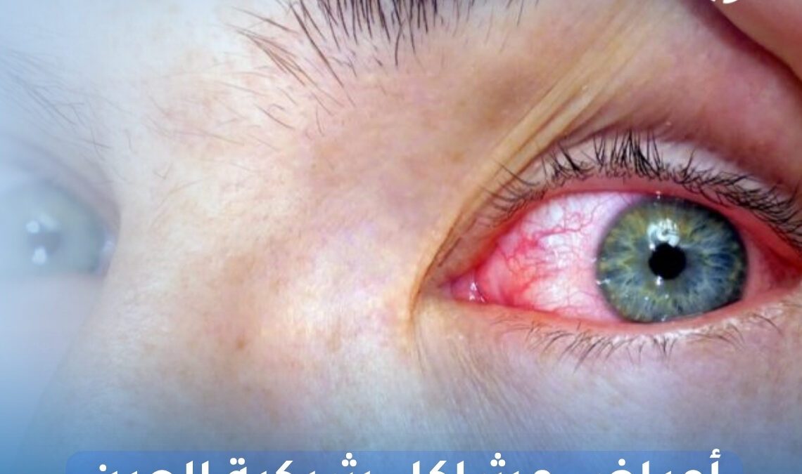 أعراض مشاكل شبكية العين