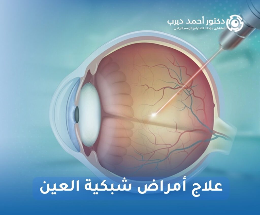 علاج أمراض شبكية العين