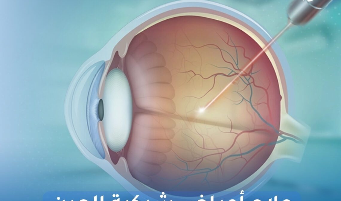 علاج أمراض شبكية العين