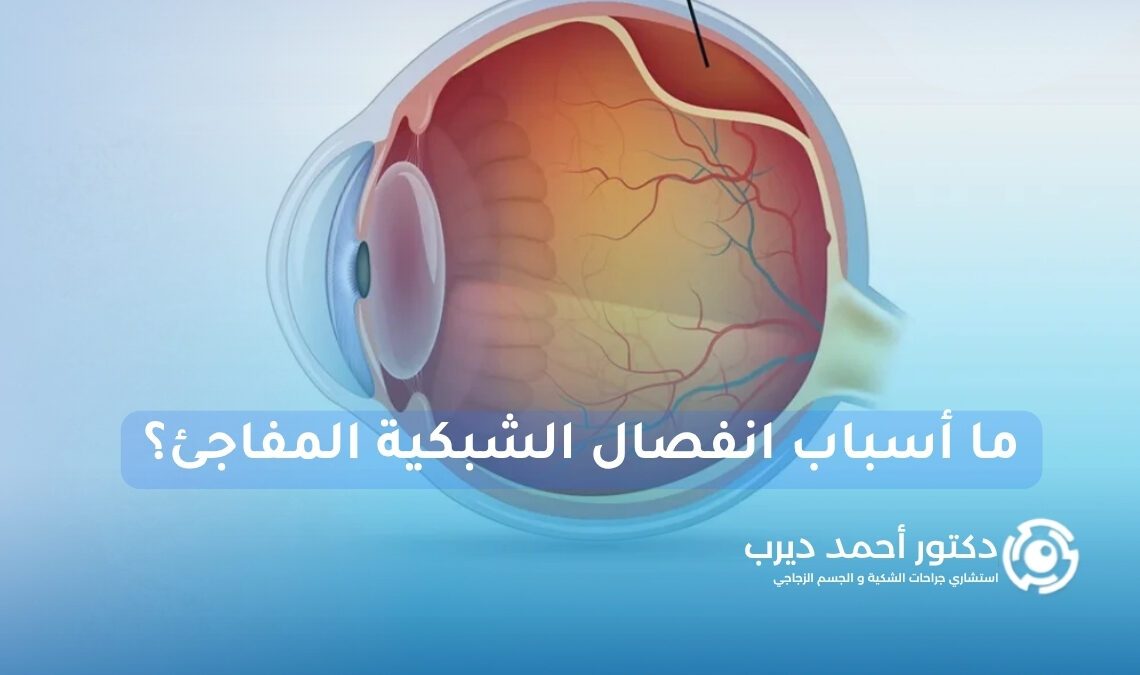 أسباب انفصال الشبكية المفاجئ