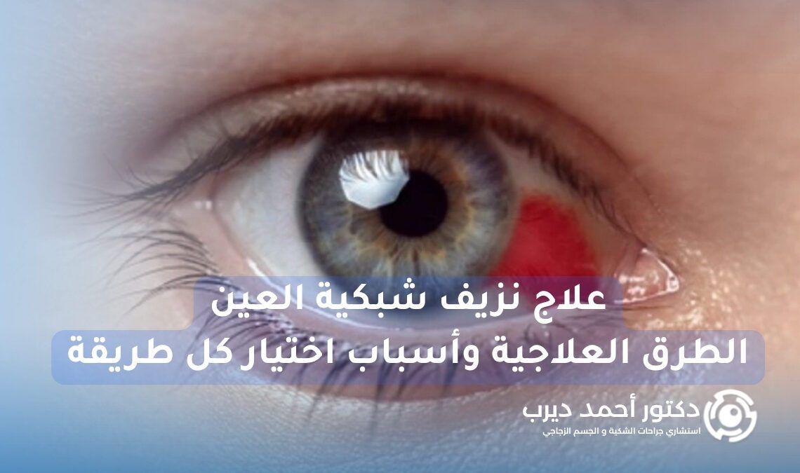 علاج نزيف شبكية العين