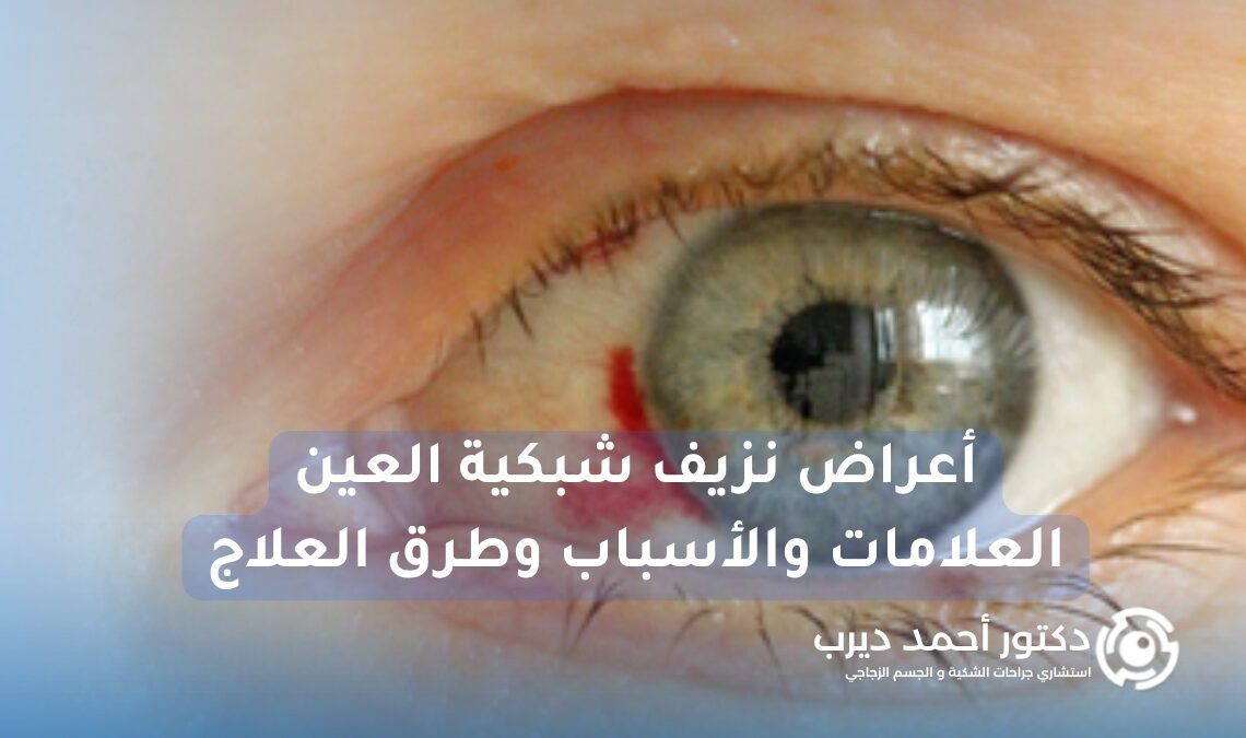 أعراض نزيف شبكية العين