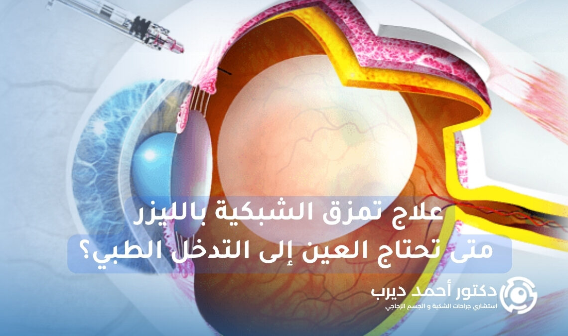 علاج تمزق الشبكية بالليزر