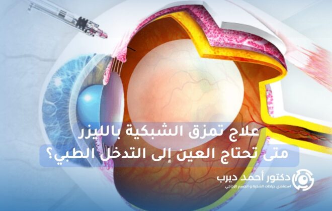 علاج تمزق الشبكية بالليزر