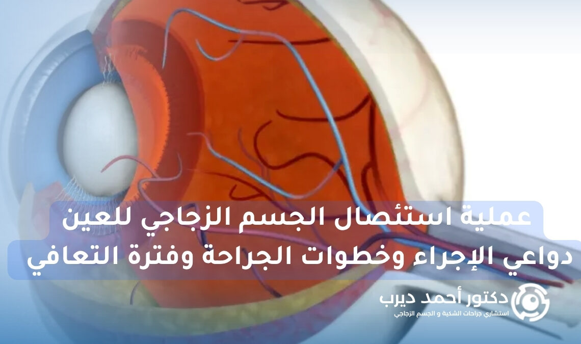 عملية استئصال الجسم الزجاجي للعين