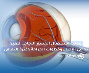 عملية استئصال الجسم الزجاجي للعين عملية استئصال الجسم الزجاجي للعين