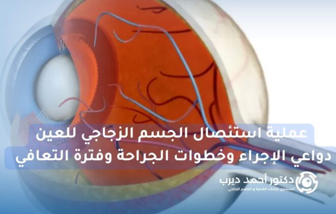 عملية استئصال الجسم الزجاجي للعين