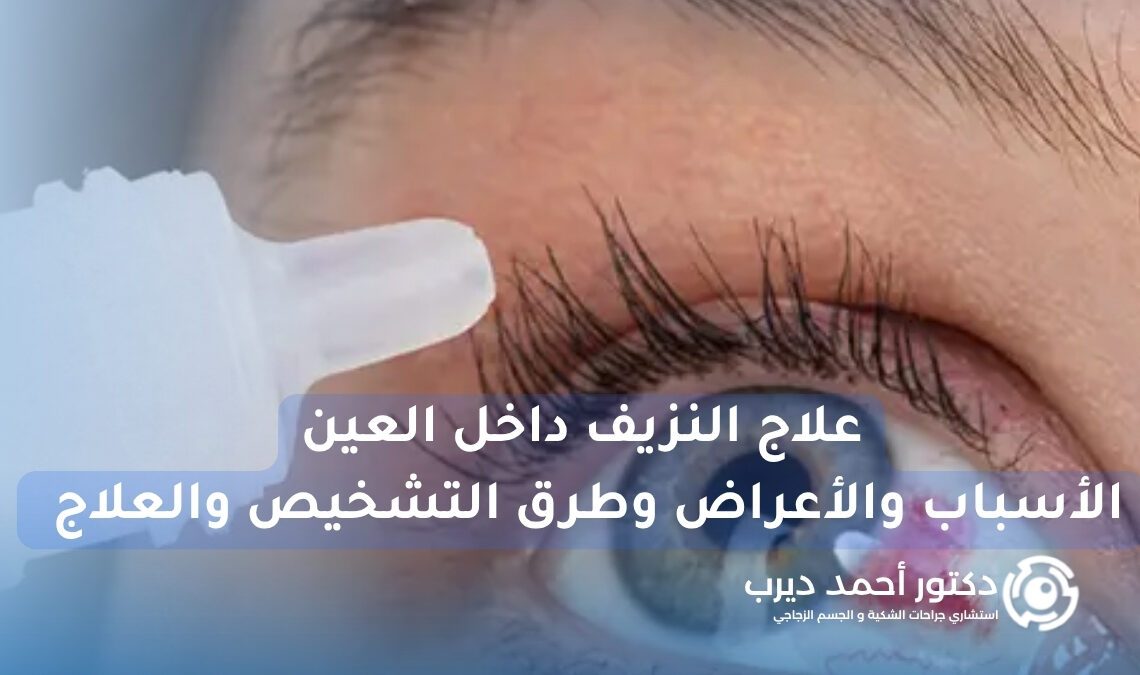 علاج النزيف داخل العين