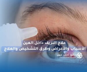 علاج النزيف داخل العين علاج النزيف داخل العين