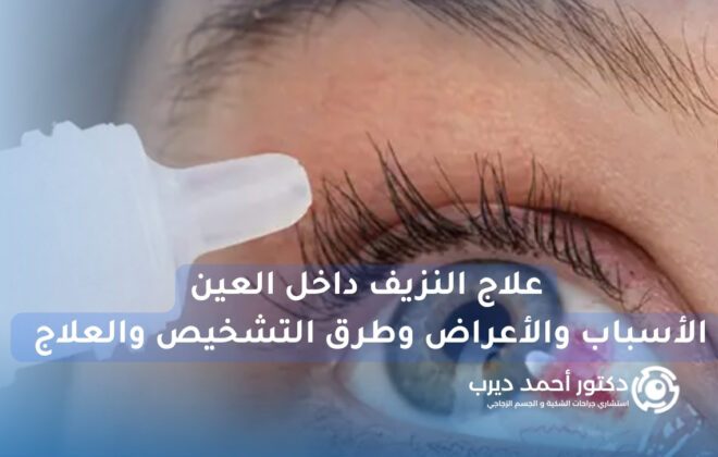 علاج النزيف داخل العين